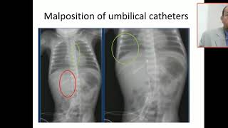 Case 13 malposition of umbilical catheter UVC [upl. by Pul70]