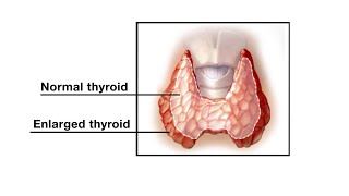 Mayo Clinic Minute  Thyroid overdrive – understanding Graves disease [upl. by Jochbed838]