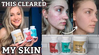 This Supplement TRANSFORMED My Skin amp Healed My Acne  Kallistia Perfect Skin Kit [upl. by Cayla]