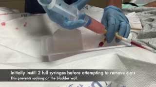 3way Foley catheter handirrigation with a Piston Syringe for Hematuria [upl. by Heyward]