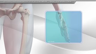 AllDorsal Scapholunate Reconstruction With InternalBrace™ Ligament Augmentation Repair [upl. by Lucas294]