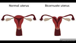 Meaning of Bicornuate uterus [upl. by Ettennek]