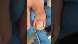 Dirty toenails clean！pedicure ingrowntoenail [upl. by Enigroeg]