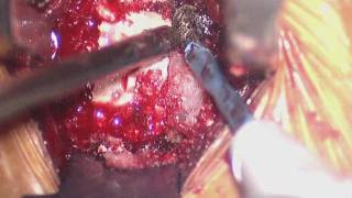 Part 4 of 4 C6C7 ACDF Cervical Spinal Fusion with Allograft [upl. by Ahsaya]