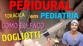 ANESTESIA PERIDURAL em PEDIATRIA  Técnica Segura [upl. by Dnomder]