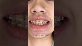 Best Braces Colors for Stained Yellow teeth [upl. by Agarhs574]