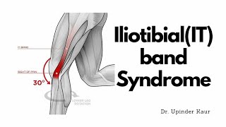 IliotibialIT band syndrome [upl. by Healy]