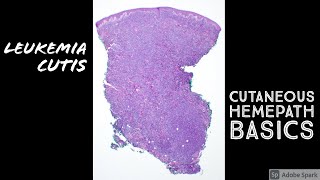 Leukemia Cutis 101 Acute Myeloid Leukemia AML in Skin Hemepath Basics for Dermatology amp Dermpath [upl. by Adnilak681]