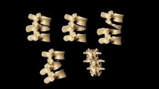 Classification of thoracolumbar injuries [upl. by Yentuoc771]