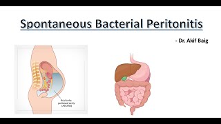 Spontaneous Bacterial Peritonitis  Dr Akif Baig [upl. by Dawna]