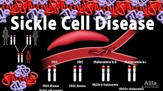 Sickle Cell Disease Animation [upl. by Bayard]