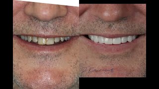 How to Fix Old Fillings SMILE MAKEOVER Australia vol82 with DrRichard 6990 for 8x Porcelain Crowns [upl. by Ardnaxela]