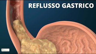 Esercizi per il REFLUSSO GASTRICO e BRUCIORE DI STOMACO [upl. by Nicholl]