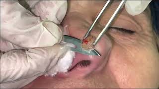 Keratoacanthoma biopsy taking [upl. by Edorej]