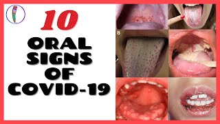 ORAL SIGNS OF CORONAVIRUS COVID 19  CORONAVIRUS SYMPTOMS [upl. by Aneehsirk]