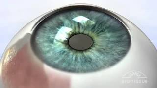 Pterygium Animation [upl. by Louth]