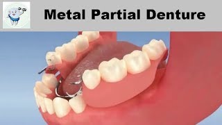 Metal Partial Denture Animation [upl. by Esadnac]