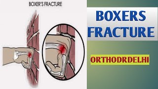 BOXERS FRACTURE IN HINDIFRACTURE OF FIFTH METACARPAL IN HINDIFRACTURE OF HAND BONE IN HINDI [upl. by Alol]