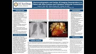 Electrocardiographic and Cardiac 3D Imaging Characteristics in Patient with Situs Inversus and PVCs [upl. by Lohman]