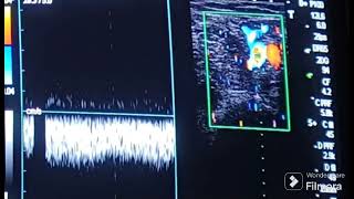 Ultrasound of Anatomy of Saphenofemoral Junction [upl. by Adnarb]