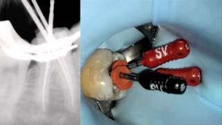 PROTAPER NEXT®  Product Overview  Dentsply Sirona [upl. by Siriso]