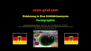 Sonographie  Einblutung In Eine Schilddrüsenzyste [upl. by Orgalim]