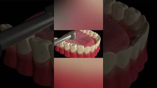 Tooth Cavity Filling Procedure tooth health shorts [upl. by Annoek]