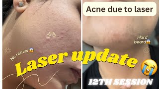 12th LaSER HAIR REMOVAL UPDATE NO RESULTS 😭 GUNJANVLOGS laserhairremoval [upl. by Delphina653]