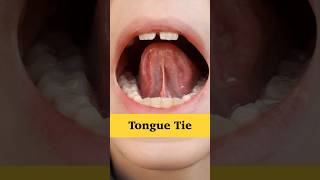 What Is Tongue Tie  Dr Saguls Paediatric corner [upl. by Akoek298]