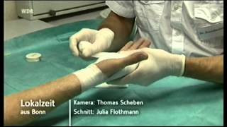 Dupuytren perkutane Nadelfasziotomie minimalinvasive Operation in Bonn [upl. by Kailey]