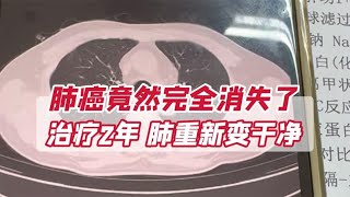 肺癌竟然完全消失了！治疗了2年，肺重新变干净了 [upl. by Cirri]