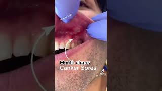 Canker sores aphthous ulcers  video tiktok trending youtubeshorts shortsvirallove youtube [upl. by Hsaniva498]