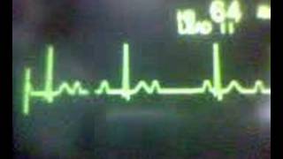 ECG Video AV Block  Second Degree Type 1 Wenckebach [upl. by Savihc845]