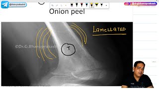 Ewings Sarcoma Hindi  Orthopedics Lecture [upl. by Aivitnahs]