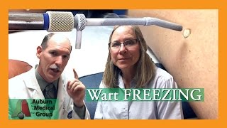 Wart Freezing  Auburn Medical Group [upl. by Anaigroeg]