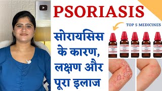 Psoriasis Homeopathic Treatment ॥ सोरायसिस के कारण लक्षण और पूरा इलाज॥ Top 5 Homeopathic Medicines [upl. by Burgess]