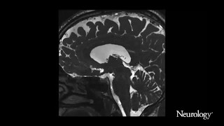 Choroid plexus hyperplasia A possible cause of hydrocephalus in adults [upl. by Veron330]