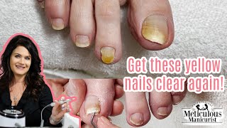 Pedicure Transformation on Yellow Toenails [upl. by Schreck]