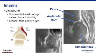 Evaluating for DDH in Newborns [upl. by Deva]