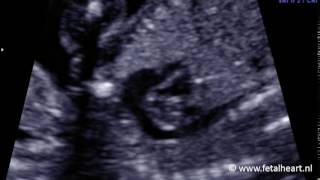 Fetal heart Academy  DORV Fallot 1 aortic arch [upl. by Aneer]