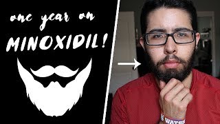 1 YEAR ON MINOXIDIL BEARD TIMELINE [upl. by Juana]