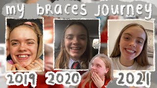 my 2 year BRACES JOURNEY what its like how to deal with it etc [upl. by Aivatal]