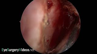 Posteriorly located frontal processlacrimal bone suture line [upl. by Ainolopa]