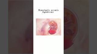 Hemolytic Uremic Syndrome kattrucate medicalreels syndrome triads rare ecoli anemia shorts [upl. by Novrej]