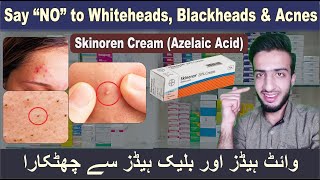 Skinoren 20 Azelaic acid  Whiteheads Blackheads amp Acnes Removal [upl. by Bartlett]