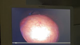 Laproscopic Hysterectomy for huge Fibroid Uterus  25kg  by Dr Rajan Shah [upl. by Inaboy]