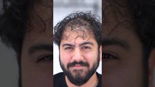 Drastic Transformation hair loss  Mridul Madhok [upl. by Whitehurst]