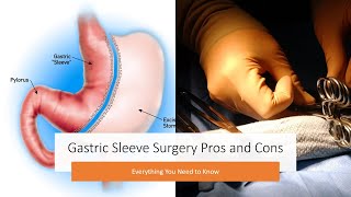 Gastric Sleeve Surgery Pros and Cons  Everything You Need to Know [upl. by Akemed677]