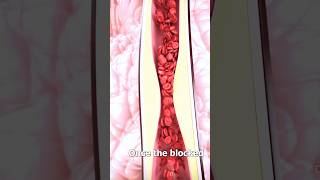 Process Of Putting Stent In Heart🤔‼️shortvideo heartstents [upl. by Atteselrahc]