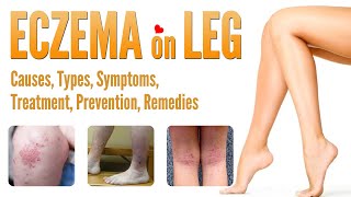 Eczema on Legs Causes Pictures Types Symptoms Treatment Prevention and Natural Home Remedies [upl. by Llenwahs]